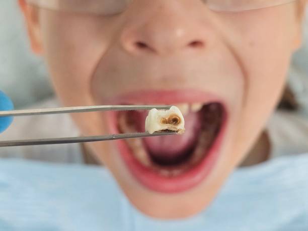 Best Emergency Root Canal Treatment in Warsaw, MO